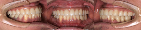 インプラント症例1 治療後