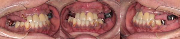 インプラント症例1 治療前