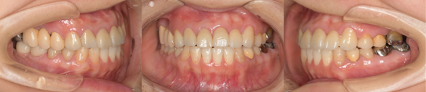 インプラント症例2 治療後