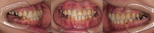 インプラント症例2 治療前